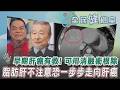 【全民健檢室】沉默器官的殺手! 藝人蔡頭.施明德罹癌病逝 早期肝癌有救? 符合這條件可用消融術根除 2大因素讓肝癌易復發! 脂肪肝不注意恐一步步走向肝癌｜TVBS新聞 @TVBSNEWS01