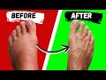 How To Shrink Swollen Ankles To Look Skinny Again