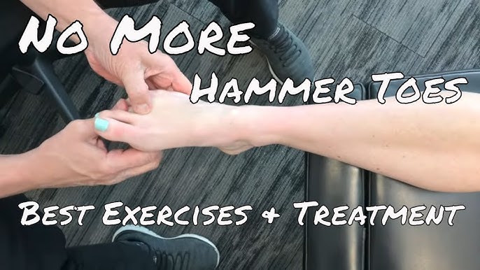 Top 5 Hammer Toe Stretches & Exercises (Avoid Surgery) (Toe Ext. Stretch) 