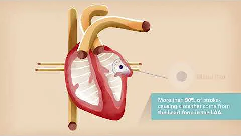 Understanding the WATCHMAN™ Procedure