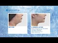 Coolsculpting uk before and afters at london premier laser clinic