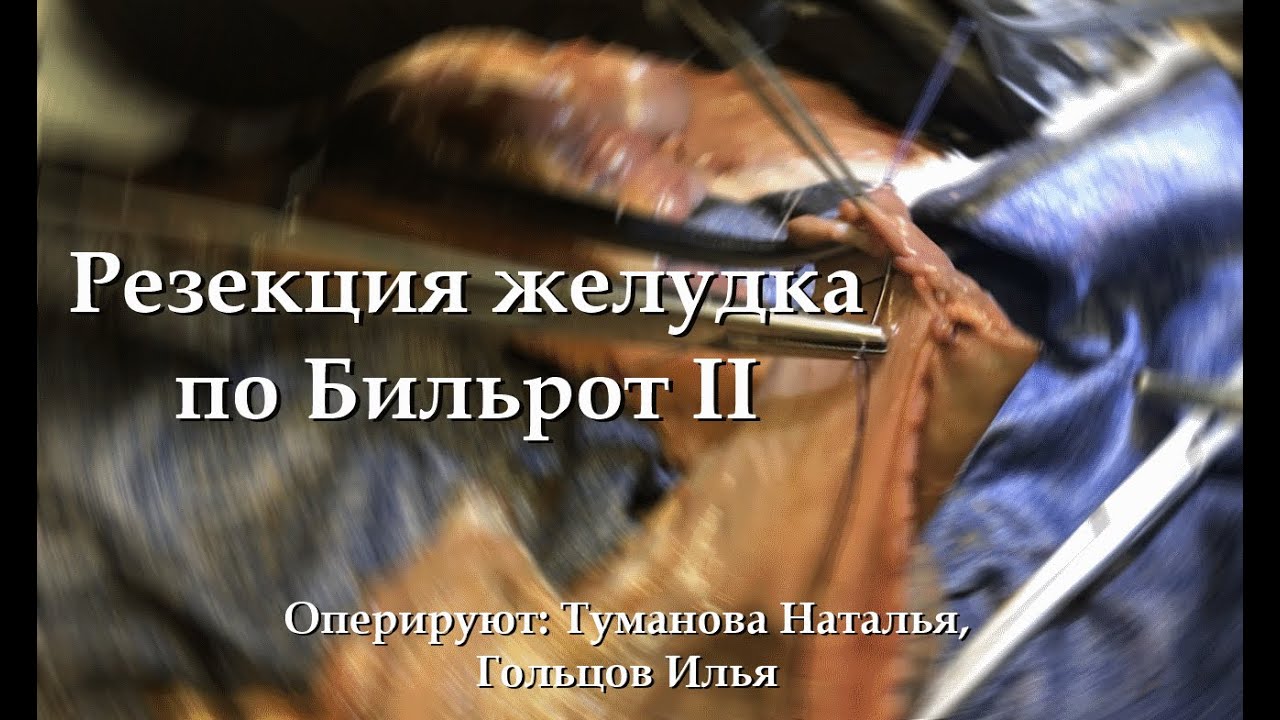 Резекция желудка по Бильрот 2 - YouTube