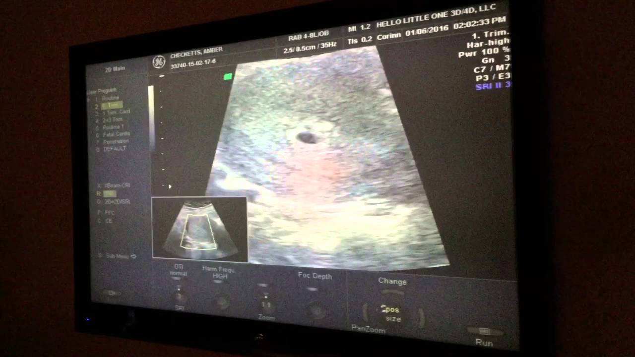 At 4 weeks ultrasound 4 Weeks