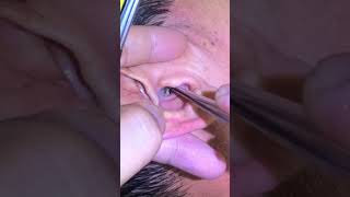 Ear Cleaning #319