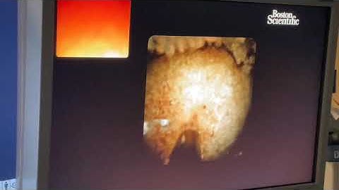 Spyglass EHL with Exalt Single Use Duodenoscope