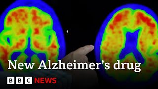 New drug brings hope to end Alzheimer