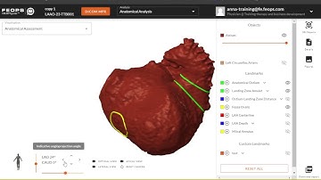 New FEops HEARTguide Release, LAAo Anatomical Analysis