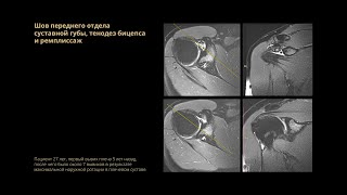 Шов переднего отдела суставной губы, тенодез бицепса и ремплиссаж