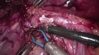 Laparoscopic ALPPS