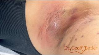 Incision and drainage of an infected cyst on top of chronic hydradenitis suppurativa