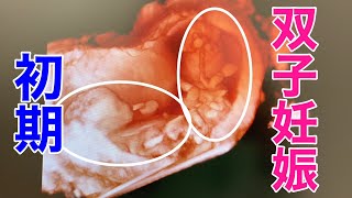 【双子妊娠・出産】妊娠初期〜管理入院前まで（一卵性双生児の妊娠18週まで）・IDENTICAL TWIN PREGNANCY : 8 - 18 weeks