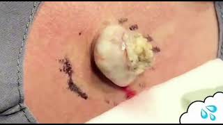 ABSCESSES BOILS CYSTS COMPILATION #10 / Выдавили гной подборка