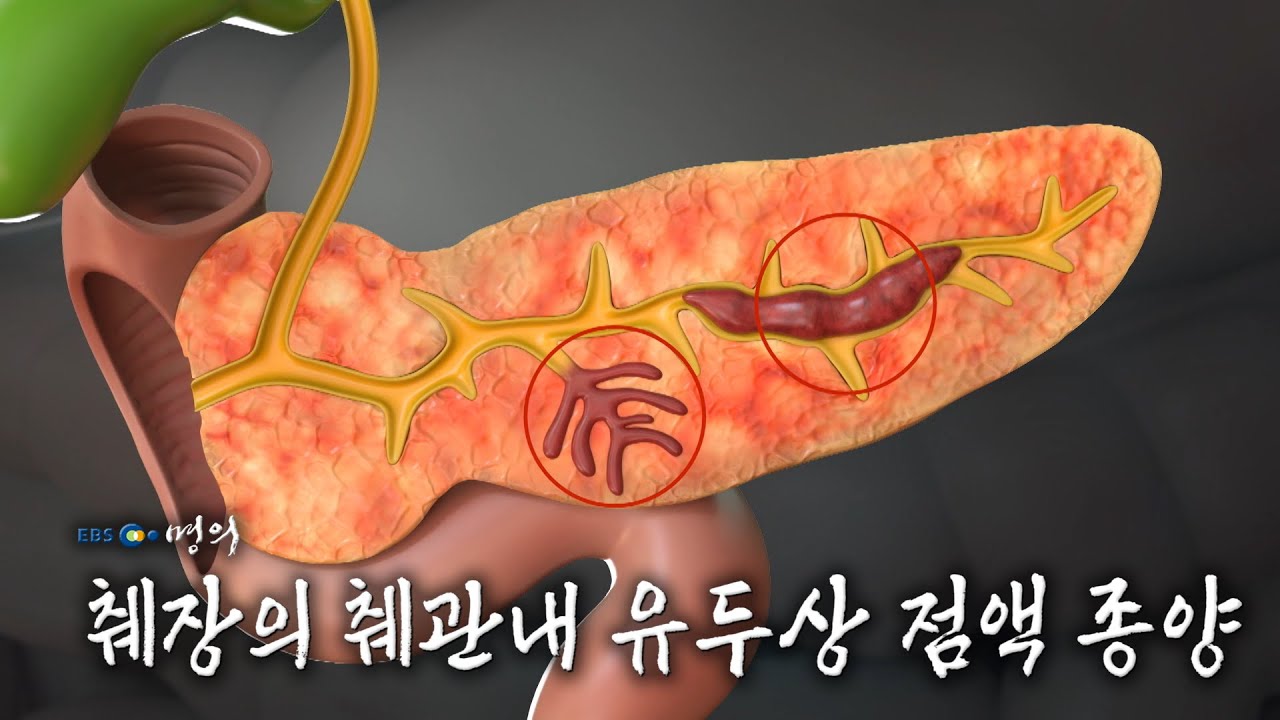 [명의 의학백과📖] 췌장의 췌관내 유두상 점액 종양 - YouTube