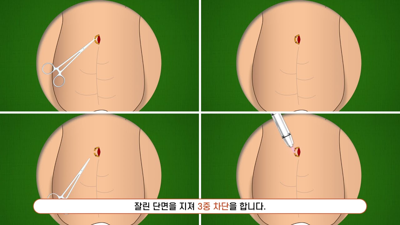 하이맨비뇨기과-무도정관수술과정(highman uro vasectomy)-비뇨의학과.남성의원