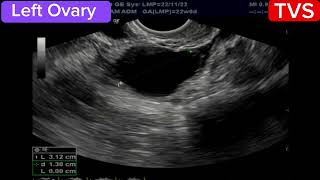 TVS Ultrasound - Bilateral multiple Ovarian Follicular Cysts