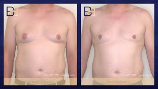 Pseudo-Gynaecoamstia With Small Gland Component Bb Grade 2B Patient 2021-7001 Before & After