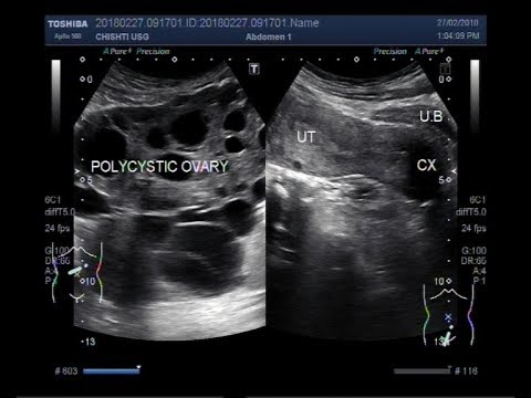 पॉलीसिस्टिक ओवरी सिंड्रोम (पीसीओएस) दिखाने वाला अल्ट्रासाउंड वीडियो।