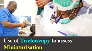 Use Of Trichoscopy To Assess Miniaturisation Bitesize With Bisanga Bhr Hair Transplantations