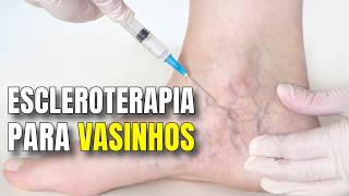 Andar a escleroterapia você após deve