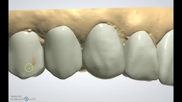 Quick Wax up (in 25 mins) in 3Shape