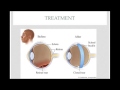 Retinal Detachment Explained  -- Quick review