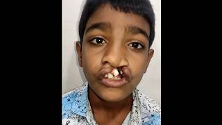 Best Cleft Lip Cleft Palate Surgery in India | Complete Treatment