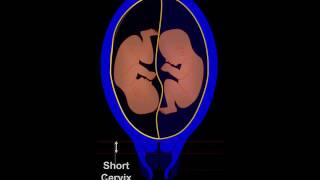 Progesterone in twin pregnancy with short cervix