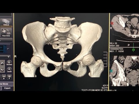 Sakrum - Koksiks BT Nasıl Çekilir ? Tomografi Nasıl Çekilir ? KANAL RADYOLOJİ Eğitim Portalı