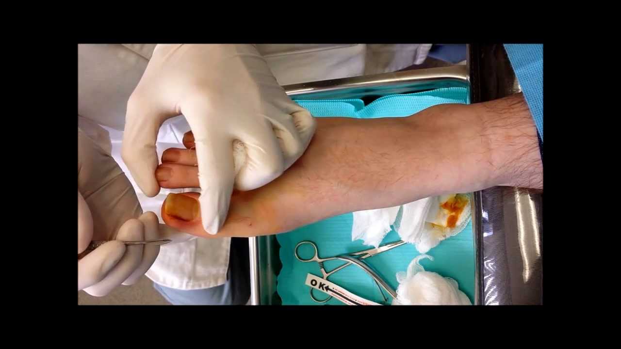 Ingrown Toe Nail Surgery with Phenol Matrixectomy - Orange County - Irvine - HB - Orange - YouTube