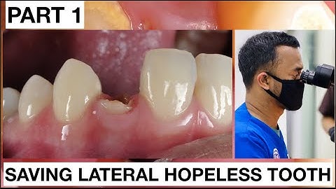 Step by Step Saving Lateral Hopeless Tooth #Part 1 | General Dentist Griya RR