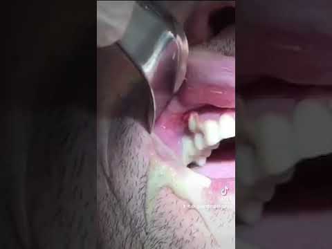 🛑HUGE dental infection and abscess - PUS drainage #shorts