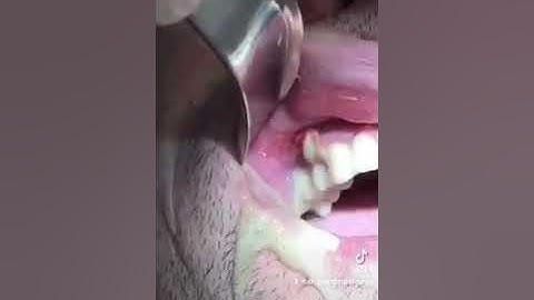 🛑HUGE dental infection and abscess - PUS drainage #shorts
