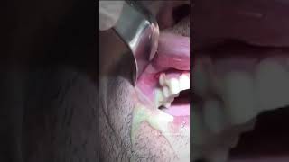 🛑HUGE dental infection and abscess - PUS drainage #shorts