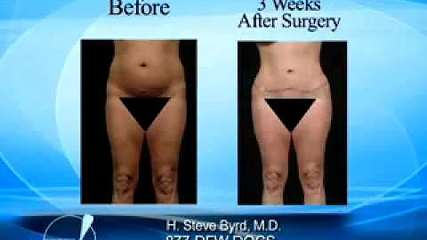 Tummy Tuck or Abdominoplasty with Plastic Surgeon ...