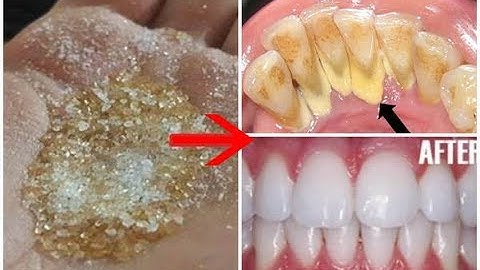 4 cách khiến cao răng cứng như đá cũng bật ra từng mảng, hôi miêng kinh niên sẽ thơm tho tức thì