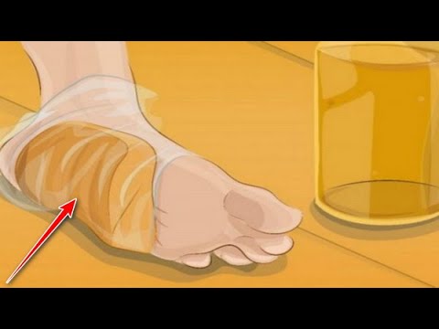 Βίντεο: Μπορούν οι κάλτσες να προκαλέσουν φουσκάλες;