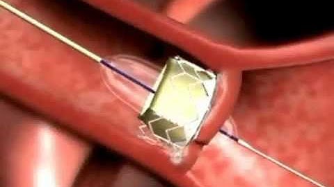 Edwards Sapien Transcatheter Heart Valve