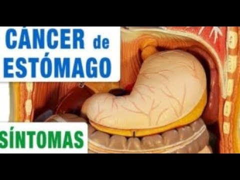 amistad meaning Si usted sufre de cáncer de estómago, estos son los signos que muestra su cuerpo