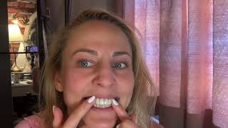 видео: Ioulia veneers! Вениры за и против мой опыт, отвалился зуб что делать картинка: Ioulia veneers! Вениры за и против мой опыт, отвалился зуб что делать