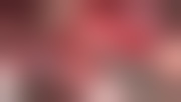 Posterior Cerebral Artery Aneurysm Clipping