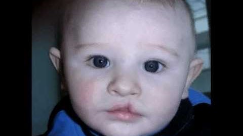 Cleft palate virtual face correction