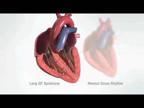Long QT Syndrome - YouTube