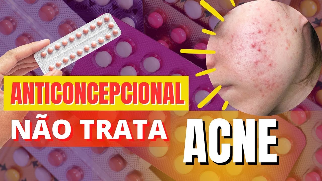 ANTICONCEPCIONAL NÃO TRATA ACNE HORMONAL (espinhas)?? Você foi enganada ...