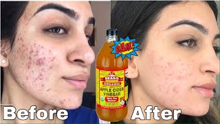 One Month Of APPLE CIDER VINEGAR On My Face To Get Rid Of Acne *SHOCKING RESULTS*