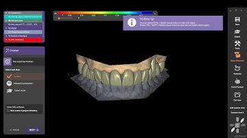 Adding a new bite to an old design and adjusting the case on EXOCAD (intraoral scan)