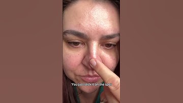 Acnecide Power Patch Skin Restore Pimple Patches