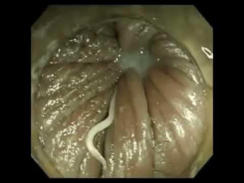 Enterobius Vermicularis(Pinworm) Infection - Youtube