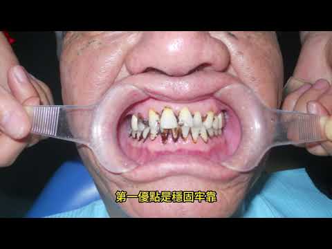 假牙不怕飛了！ BPS吸附性義齒