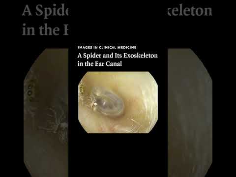 A Spider and Its Exoskeleton in the Ear Canal | NEJM