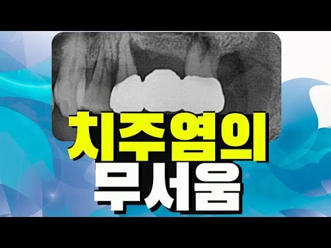 증상이 거의 없는 잇몸병 치주질환 치주염의 무서움